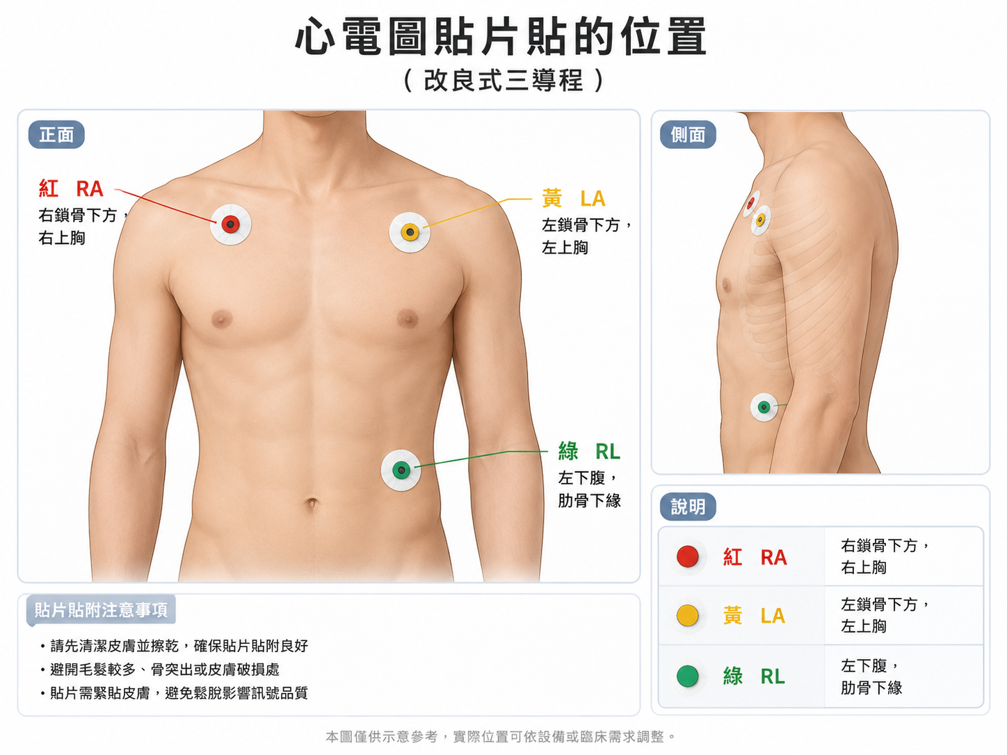 貼法 A：改良式三導程，貼在胸口